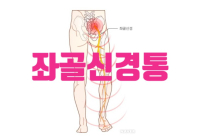 [일문일답 생활 속 건강] 디스크의 이웃사촌 ‘좌골신경통’