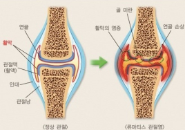 ‘늦게 늙자’ 슬로우 에이징 테크 ⑬ 무릎이 삶의 질을 좌우한다