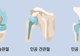 나이 들어 자주 아픈 무릎...이런 보험으로 대비하세요