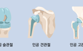 나이 들어 자주 아픈 무릎...이런 보험으로 대비하세요