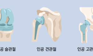 나이 들어 자주 아픈 무릎...이런 보험으로 대비하세요