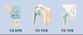 나이 들어 자주 아픈 무릎...이런 보험으로 대비하세요