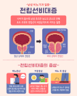 [특별기획] 전립선 질환의 예방과 치료 ② 전립선 비대증 원인과 증상